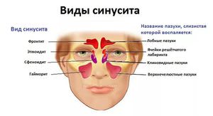 Прчиины заболевания пансинусита