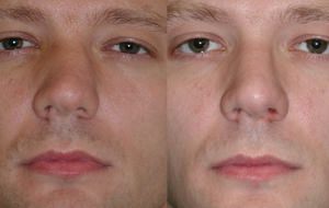 Изменение внешнего вида после коррекции носа
