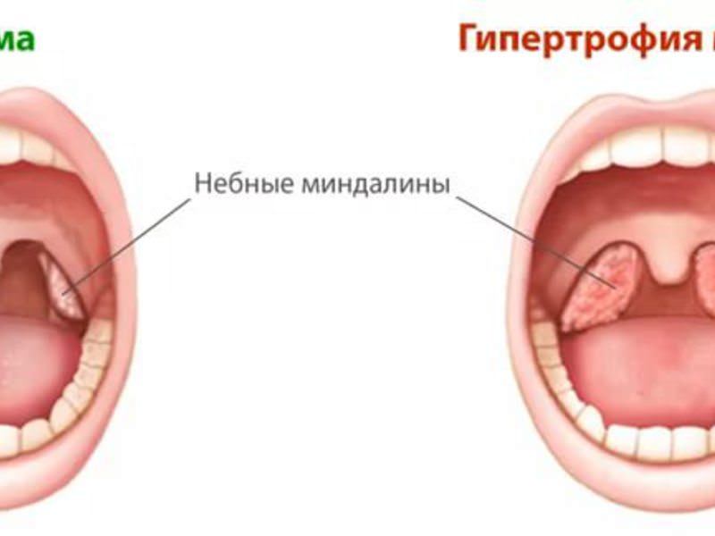 Профилактика заболеваний горла