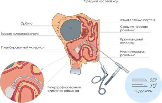 Эндоскопическая операция при гайморите