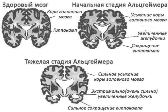 Стадии поражения мозга при болезни Альцгеймера