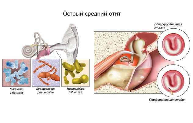 Заболевание уха