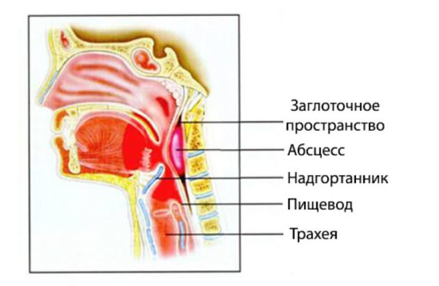 Заглоточный абсцесс может вызвать боль в горле с одной стороны