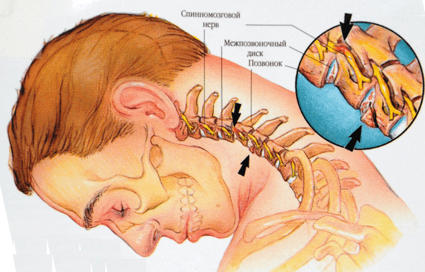 Миогелоз шейного отдела позвоночника