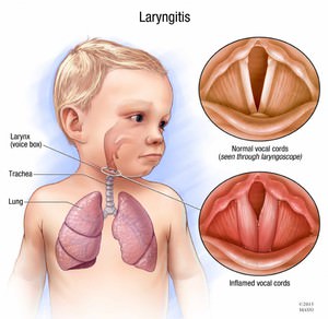 Аллергический ларингит у детей